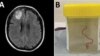 An 8-centimeter worm has been found alive in the brain of a woman in Australia. 