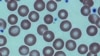 FILE - Red blood cells in a sickle-cell patient following a bone marrow transplant at the National Institutes of Health Clinical Center, Bethesda, Md.
