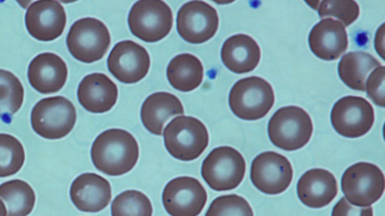 FILE - Red blood cells in a sickle-cell patient following a bone marrow transplant at the National Institutes of Health Clinical Center, Bethesda, Md.