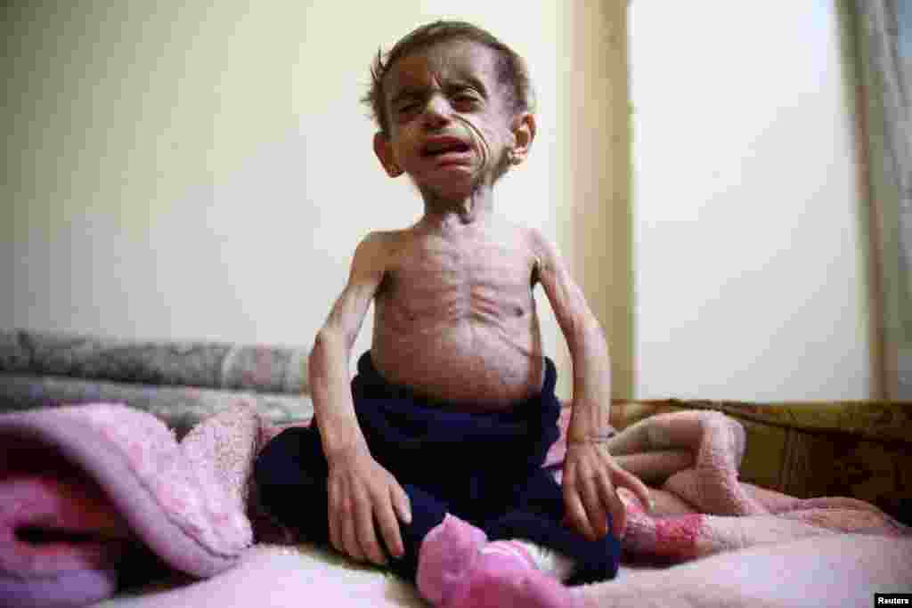 Two-and-a-half year old Hala al-Nufi, who suffers from a metabolic disorder which is worsening due to the siege and food shortages in the eastern Ghouta, reacts as she sits on a bed in the Saqba area, in the eastern Damascus suburb of Ghouta, Syria.